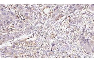 ABIN6273935 at 1/100 staining Human liver cancer tissue by IHC-P. (GPR39 anticorps  (C-Term))