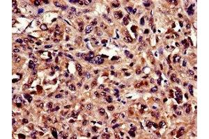 Immunocytochemistry analysis of human melanoma using ABIN7174228 at dilution of 1:100