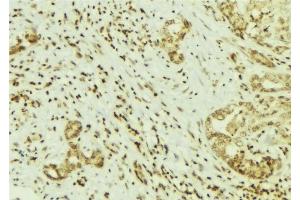 ABIN6269141 at 1/100 staining Human breast cancer tissue by IHC-P. (Src anticorps  (N-Term))
