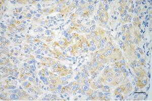 Immunohistochemistry was performed on paraffin-embedded human hepatocarcinoma using USO1 antibody (ABIN7800775), 1:200).