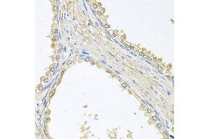 Immunohistochemistry of paraffin-embedded human prostate using PMM2 antibody at dilution of 1:100 (x40 lens). (PMM2 anticorps)