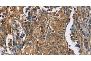 Immunohistochemistry of paraffin-embedded Human cervical cancer tissue using TAC1 Polyclonal Antibody at dilution 1:25 (TAC1 anticorps)