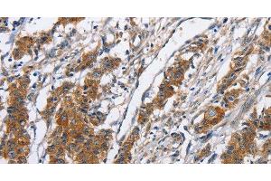 Immunohistochemistry of paraffin-embedded Human gasrtic cancer tissue using NCAPD3 Polyclonal Antibody at dilution 1:50