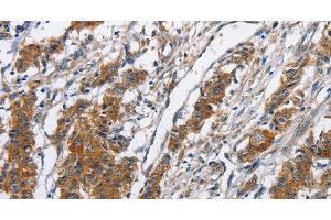 Immunohistochemistry of paraffin-embedded Human gasrtic cancer tissue using NCAPD3 Polyclonal Antibody at dilution 1:50 (NCAPD3 anticorps)