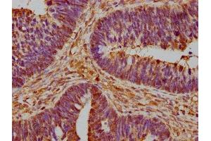 IHC image of ABIN7142780 diluted at 1:600 and staining in paraffin-embedded human ovarian cancer performed on a Leica BondTM system.