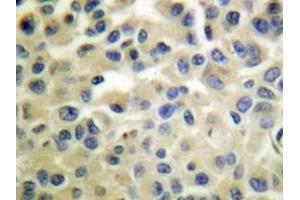 Immunohistochemistry analyzes of IKKα/β antibody in paraffin-embedded human breast carcinoma tissue. (IKK alpha anticorps)