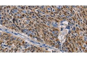 Immunohistochemistry of paraffin-embedded Human lung cancer tissue using GSTA2 Polyclonal Antibody at dilution 1:50 (GSTa2 anticorps)