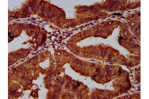 IHC image of ABIN7148760 diluted at 1:600 and staining in paraffin-embedded human endometrial cancer performed on a Leica BondTM system.