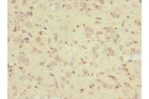 Immunohistochemistry of paraffin-embedded human glioma using ABIN7167625 at dilution of 1:100 (RGS anticorps  (AA 230-350))