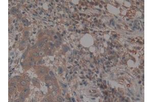 IHC-P analysis of Human Breast cancer Tissue, with DAB staining. (TEP1 anticorps  (AA 2368-2627))