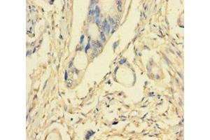 Immunohistochemistry of paraffin-embedded human pancreatic cancer using ABIN7163295 at dilution of 1:100 (PIK3R5 anticorps  (Regulatory Subunit 5))