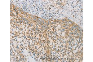 Immunohistochemistry of Human thyroid cancer using REN Polyclonal Antibody at dilution of 1:40 (Renin anticorps)