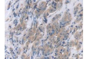 Detection of CRP in Human Breast cancer Tissue using Polyclonal Antibody to C Reactive Protein (CRP) (CRP anticorps  (AA 17-224))