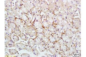 Formalin-fixed and paraffin embedded human colon carcinoma tissue labeled with Rabbit Anti-RAB7 Polyclonal Antibody at 1:200 followed by conjugation to the secondary antibody and DAB staining.