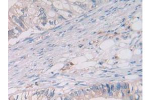 IHC-P analysis of Human Rectum Cancer Tissue, with DAB staining. (Cathepsin S anticorps  (AA 115-331))