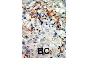 Formalin-fixed and paraffin-embedded human cancer tissue reacted with the primary antibody, which was peroxidase-conjugated to the secondary antibody, followed by AEC staining. (EPH Receptor A3 anticorps  (N-Term))