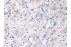 Detection of PFN2 in Human Glioma Tissue using Polyclonal Antibody to Profilin 2 (PFN2)