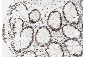 ABIN6267281 at 1/200 staining human colon carcinoma sections by IHC-P.