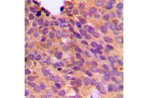 Immunohistochemical analysis of NT5C1B staining in human breast cancer formalin fixed paraffin embedded tissue section.