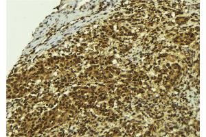 ABIN6273779 at 1/100 staining Human breast cancer tissue by IHC-P. (BCL2L13 anticorps  (Internal Region))