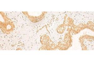Immunohistochemistry of paraffin-embedded Human breast cancer tissue using GSG1L Polyclonal Antibody at dilution of 1:50(x200) (GSG1-Like anticorps)