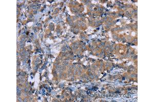 Immunohistochemistry of Human breast cancer using PON1 Polyclonal Antibody at dilution of 1:40 (PON1 anticorps)