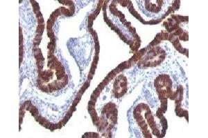 Formalin-fixed, paraffin-embedded human ovarian carcinoma stained with Cytokeratin 7 antibody (KRT7/760) (Cytokeratin 7 anticorps)