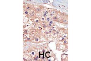 Formalin-fixed and paraffin-embedded human hepatocellular carcinoma tissue reacted with UHMK1 polyclonal antibody  , which was peroxidase-conjugated to the secondary antibody, followed by DAB staining. (UHMK1 anticorps  (N-Term))