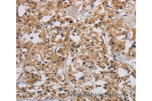 Immunohistochemistry of Human liver cancer using INPPL1 Polyclonal Antibody at dilution of 1:40