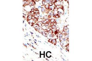 Formalin-fixed and paraffin-embedded human hepatocellular carcinoma tissue reacted with PIAS1 polyclonal antibody , which was peroxidase-conjugated to the secondary antibody, followed by DAB staining. (PIAS1 anticorps  (C-Term))
