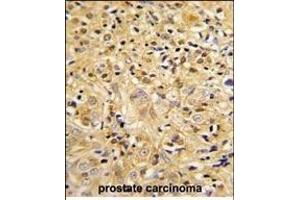 Formalin-fixed and paraffin-embedded human prostate carcinoma reacted with LUM Antibody (Center), which was peroxidase-conjugated to the secondary antibody, followed by DAB staining. (LUM anticorps  (AA 198-227))