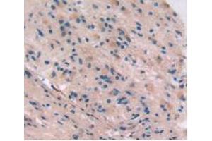 IHC-P analysis of Human Glioma Tissue, with DAB staining. (Integrin beta 5 anticorps  (AA 137-378))