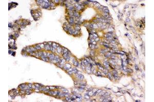 WNK1 was detected in paraffin-embedded sections of human intestinal cancer tissues using rabbit anti-WNK1 Antigen Affinity purified polyclonal antibody (Catalog # ) at 1 µg/mL.