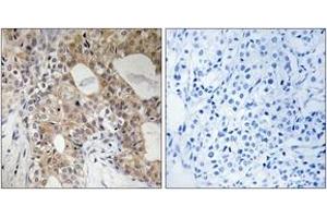 Immunohistochemistry analysis of paraffin-embedded human breast carcinoma, using SPHK2 (Phospho-Thr614) Antibody.