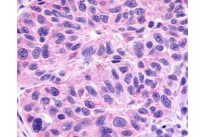 Anti-GPR78 antibody IHC of human Skin, Melanoma.