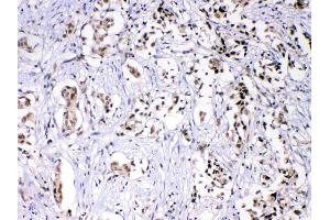 HnRNPF was detected in paraffin-embedded sections of human mammary cancer tissues using rabbit anti- HnRNPF Antigen Affinity purified polyclonal antibody (Catalog # ) at 1 µg/mL.