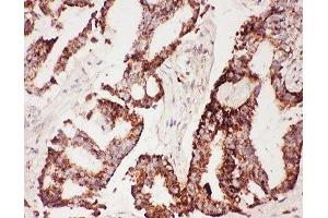 IHC-P: CNTF antibody testing of human lung cancer tissue