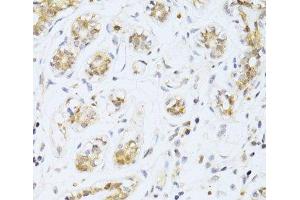 Immunohistochemistry of paraffin-embedded Human breast cancer using ETV1 Polyclonal Antibody at dilution of 1:100 (40x lens). (ETV1 anticorps)