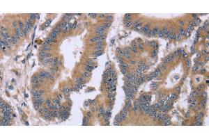 Immunohistochemistry of paraffin-embedded Human colon cancer tissue using KIAA1324 Polyclonal Antibody at dilution 1:30 (ELAPOR1 anticorps)