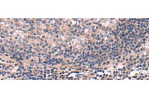 Immunohistochemistry of paraffin-embedded Human tonsil tissue using KCNT1 Polyclonal Antibody at dilution of 1:30(x200) (KCNT1 anticorps)