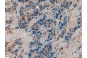 Detection of CHI3L1 in Human Breast cancer Tissue using Polyclonal Antibody to Chitinase-3-like Protein 1 (CHI3L1) (CHI3L1 anticorps  (AA 112-377))