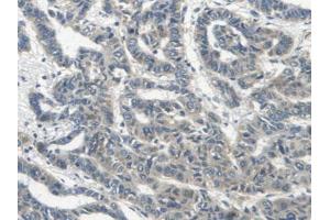 IHC-P analysis of Human Lung Cancer Tissue, with DAB staining. (ERBB4 anticorps  (AA 29-278))