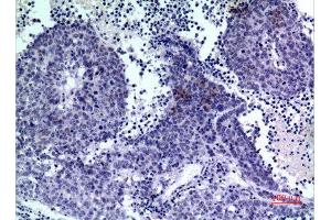 Immunohistochemistry (IHC) analysis of paraffin-embedded Human Lung Cancer, antibody was diluted at 1:100.