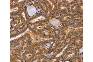 Immunohistochemistry of Human lymphoma using CCL23 Polyclonal Antibody at dilution of 1:50 (CCL23 anticorps)