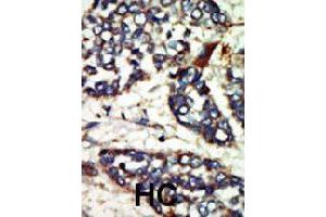 Formalin-fixed and paraffin-embedded human hepatocellular carcinoma tissue reacted with NEK1 polyclonal antibody  , which was peroxidase-conjugated to the secondary antibody, followed by DAB staining. (NEK1 anticorps  (C-Term))