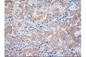 Immunohistochemical staining of paraffin-embedded liver tissue using anti-KRT19mouse monoclonal antibody. (Cytokeratin 19 anticorps  (AA 240-390))