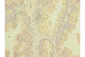 Immunohistochemistry of paraffin-embedded human prostate cancer using ABIN7171826 at dilution of 1:100 (TSGA10 anticorps  (AA 1-200))