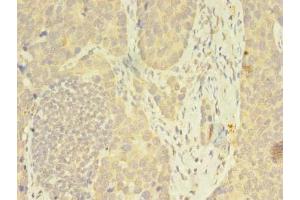 Immunohistochemistry of paraffin-embedded human gastric cancer using ABIN7162815 at dilution of 1:100 (FKBP11 anticorps  (AA 28-154))