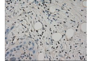 Immunohistochemical staining of paraffin-embedded Carcinoma of pancreas tissue using anti-SLC2A5mouse monoclonal antibody.