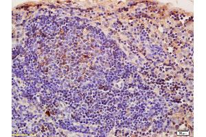 Formalin-fixed and paraffin embedded rat pancreatic cancer labeled with Anti-CRIM1 Polyclonal Antibody, Unconjugated (ABIN676853) at 1:200, followed by conjugation to the secondary antibody and DAB staining (CRIM1 anticorps  (AA 901-1028))